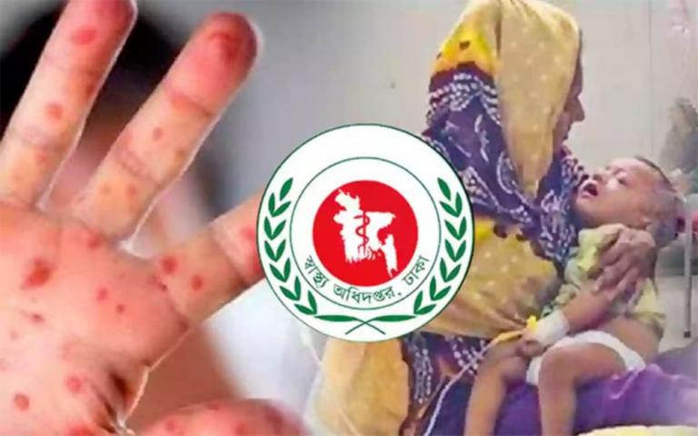 হাম ও উপসর্গে আরও ৫ শিশুর মৃত্যু, নতুন আক্রান্ত ১,০২০